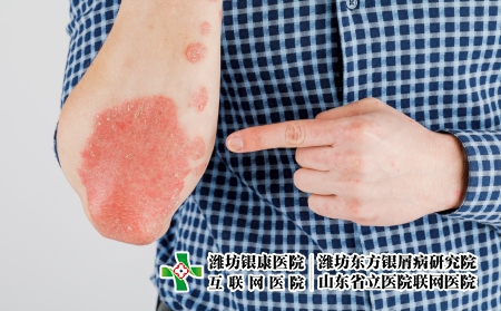 摄图网_506432486_患有粗俗的牛皮癣湿疹和其他皮肤病（企业商用）.jpg